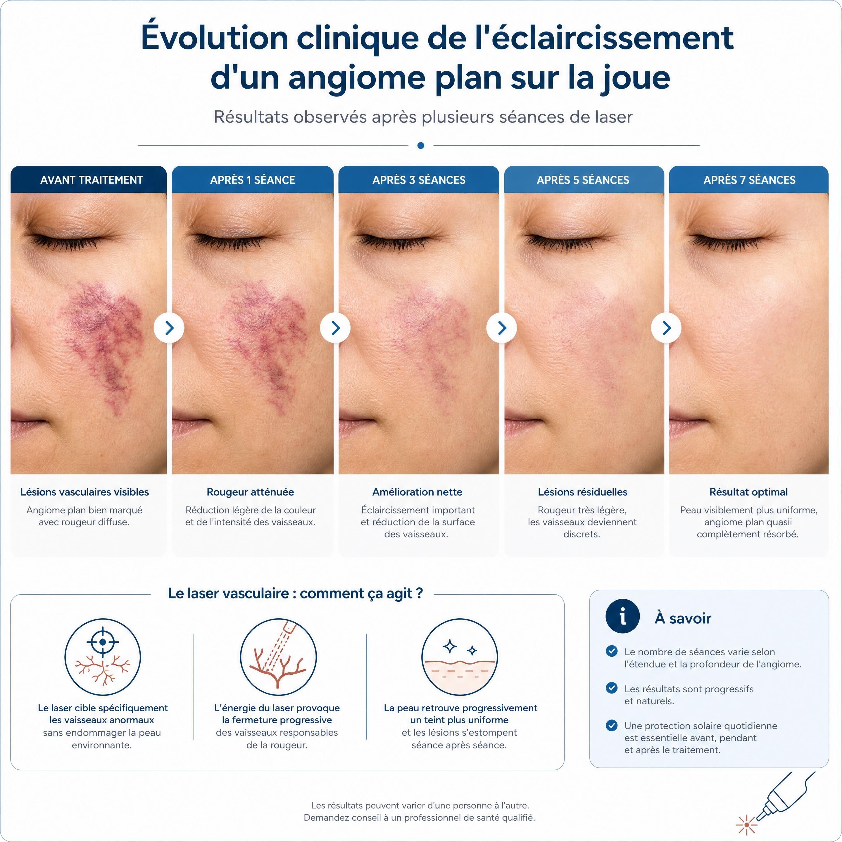 Évolution clinique de l'éclaircissement d'un angiome plan sur la joue après plusieurs séances de laser