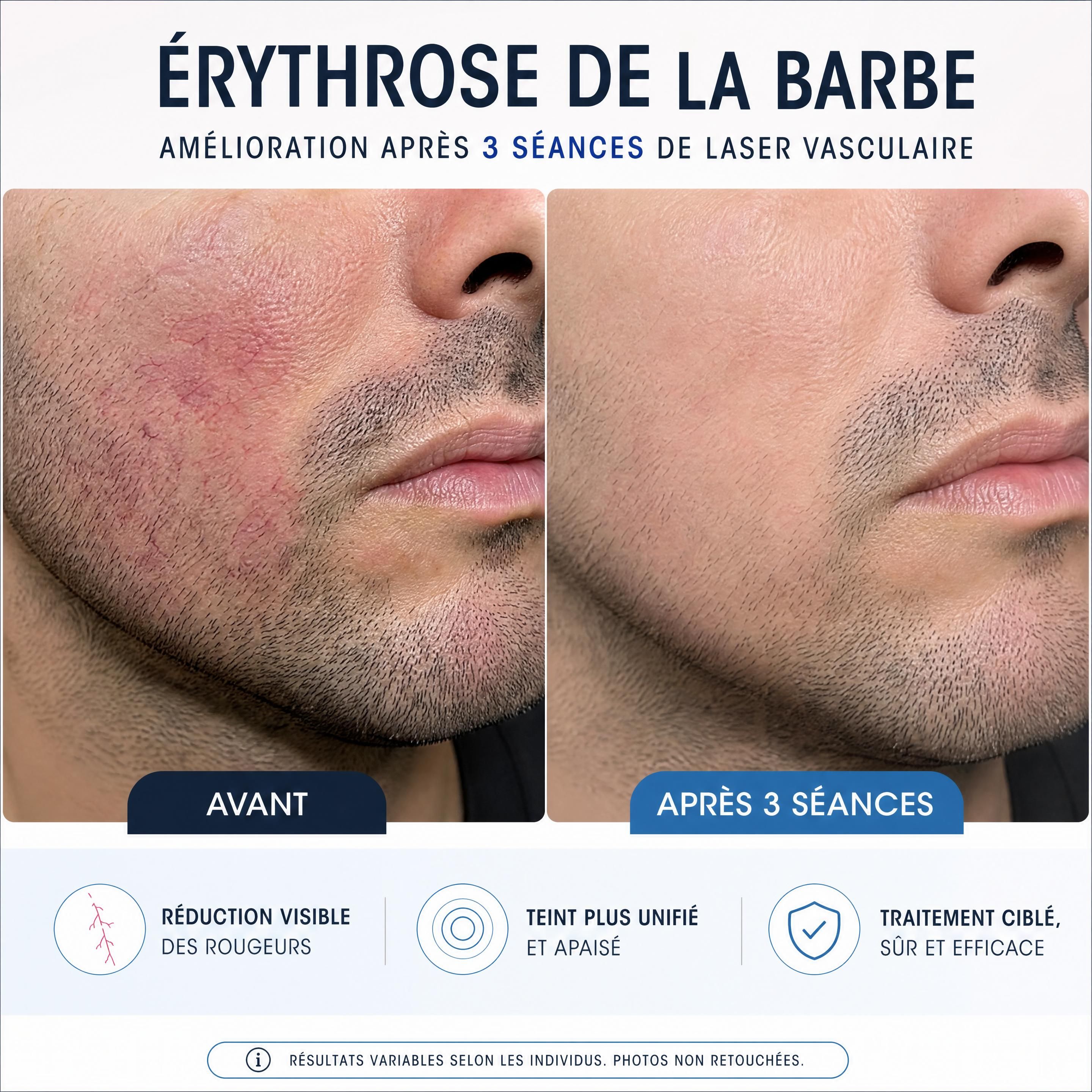 Gros plan sur l'amélioration d'une érythrose de la barbe chez un homme après 3 séances de laser vasculaire