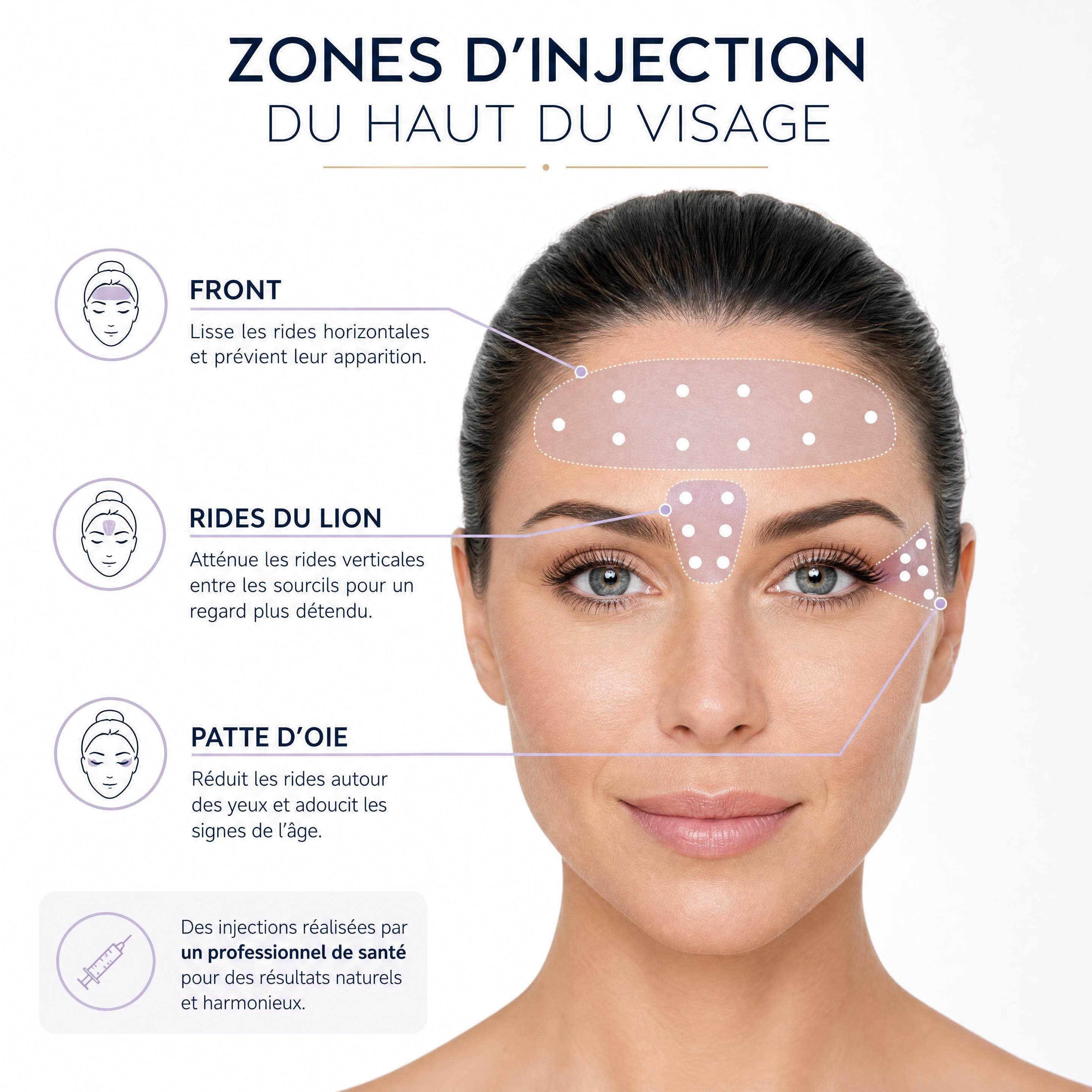 Schéma des zones d'injection du haut du visage : front, rides du lion et patte d'oie